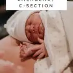 Plus Size Emergency C-Section